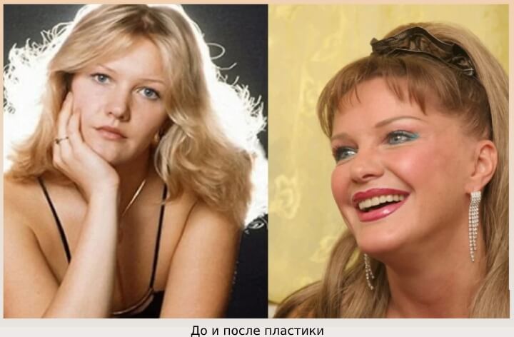 До и после пластики
